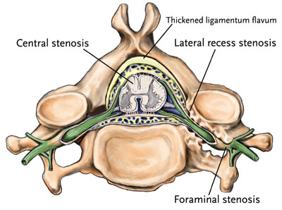 types stenosis